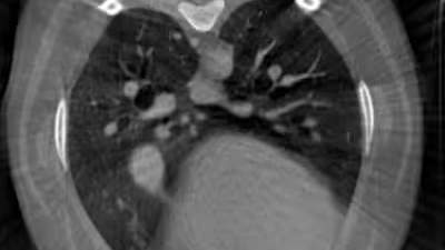 Sample DICOM lung CT scan image for upload